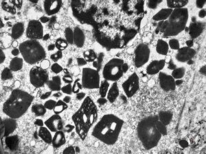 M,58y. | crystalline inclusions in hepatocyte after unknown medication